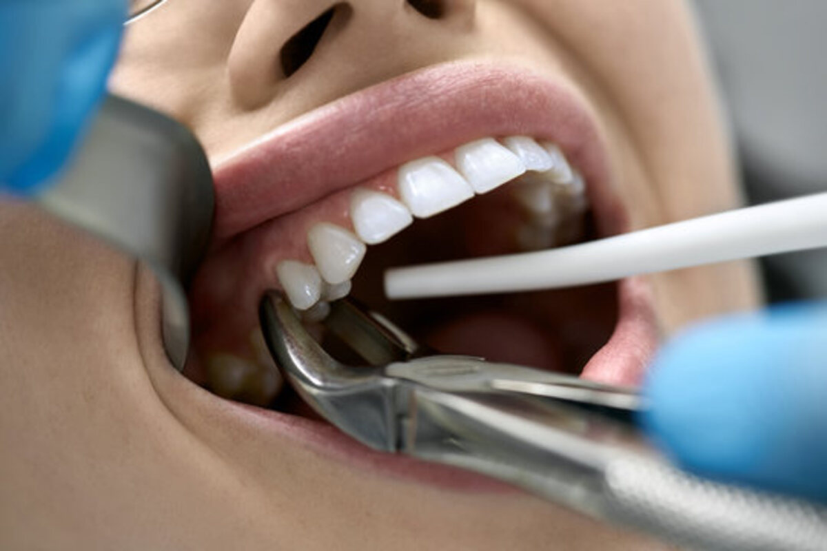 Tooth extraction procedure using dental forceps