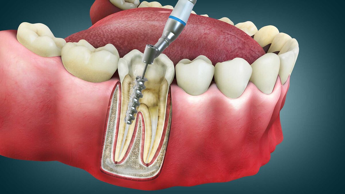 Root canal myths article placeholder