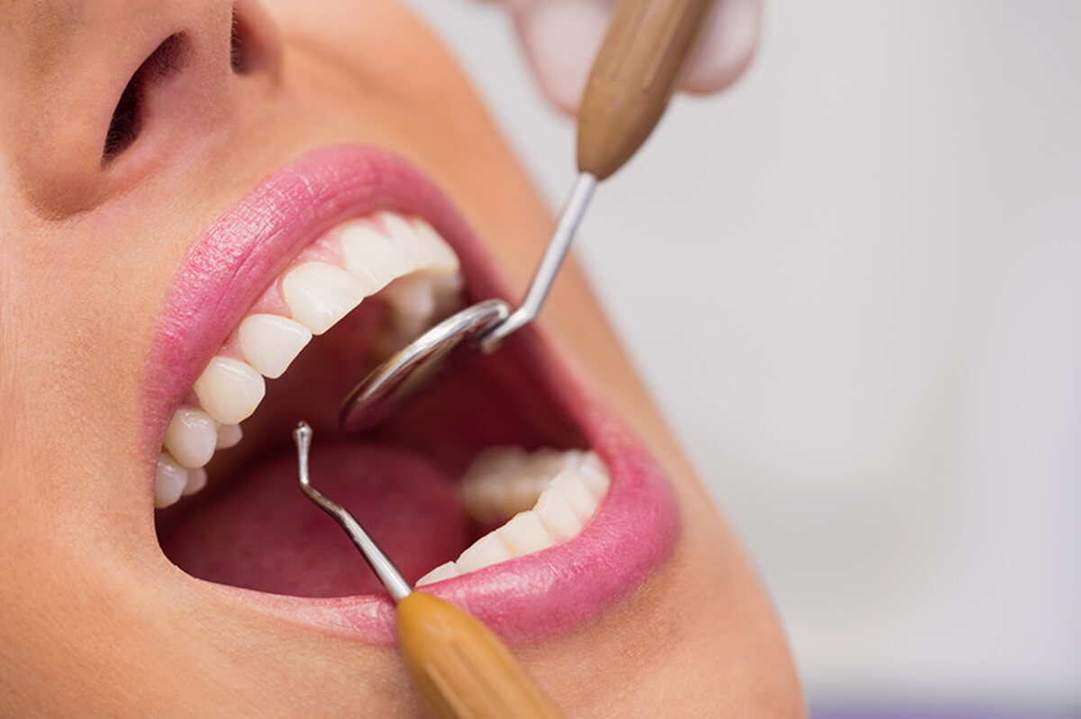 Dental scaling and polishing in progress